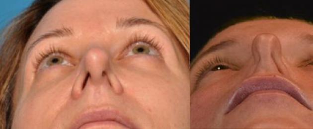 Che aspetto ha un setto nasale deviato?  È chiaro