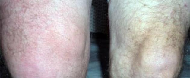 Почему начинается артрит коленного сустава. Артрит коленного сустава - причины, симптомы, лечение