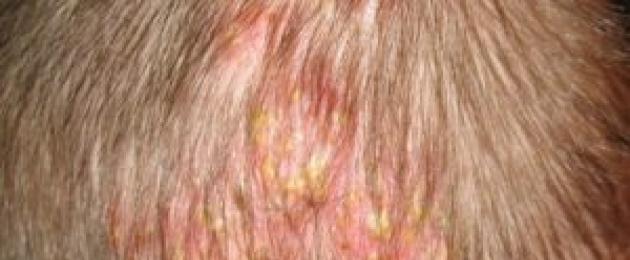 Герпес под волосами: что это такое и как лечить? Основные симптомы недуга. Что такое фолликулит, расскажет это видео