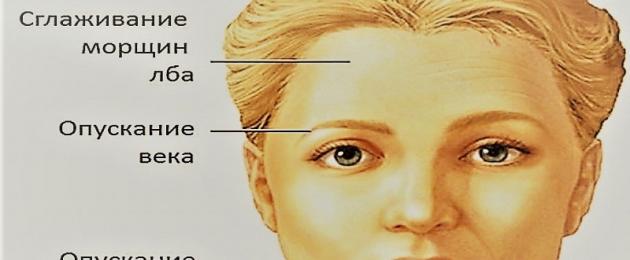Невропатия лицевого нерва диагностика. Поражения лицевого нерва в практике врача