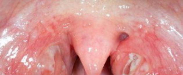 Стафилококк в горле: что это такое, симптомы, как лечить. Золотистый стафилококк в горле: симптомы и лечение