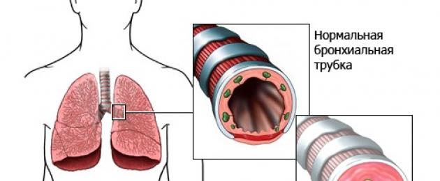 Codice ICD per l'asma bronchiale, forma atopica.  Asma bronchiale: cause della malattia e metodi di trattamento negli adulti