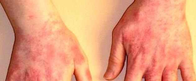 Бытовой дерматит на руках. Как проявляется дерматит на руках: фото, симптомы и способы лечения