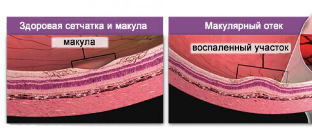 Edema cistico dell'area maculare.  Edema maculare della retina: cause e trattamento Edema cistico dell'occhio