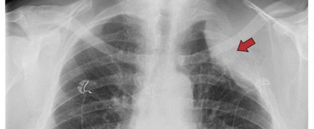 Fluido nel polmone ai raggi X.  Oscuramento nel polmone destro alla radiografia, cosa potrebbe essere?