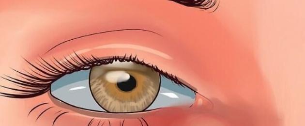 عين الثعبان مرض يصيب الإنسان.  فيديو: جراحة إعتام عدسة العين