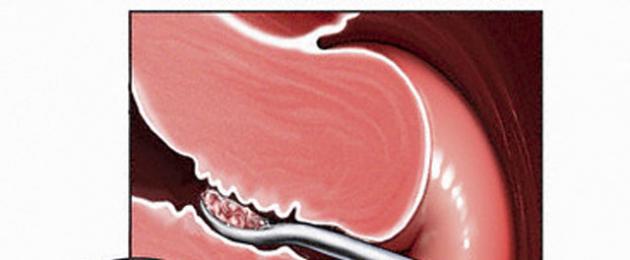 Quali sono i segni dell'endometrite.  Endometrite: trattamento dell'endometrite cronica e acuta, è possibile rimanere incinta