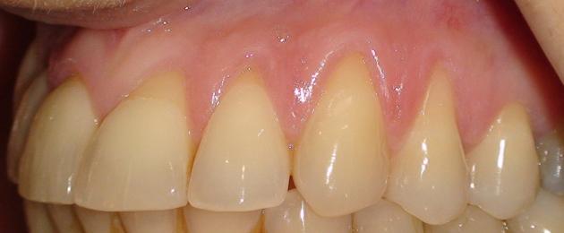 Десна открывает шейку зуба. Методы и средства для лечения оголения