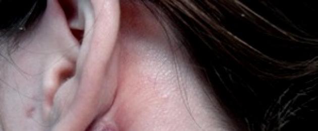 Причины образования шарика в мочке уха, характерные признаки и методы терапии. Шарик в мочке уха