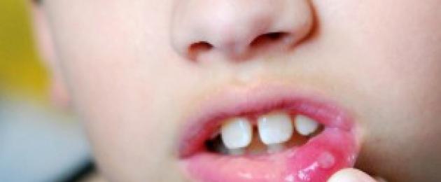 Под губой прозрачный пузырек. Опасны ли шишки с внутренней стороны губы? Диагностика и лечение кисты на губе