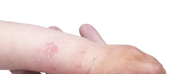 Come trattare l'eczema microbico in un bambino.  Eczema: come si manifesta e come si cura nei bambini
