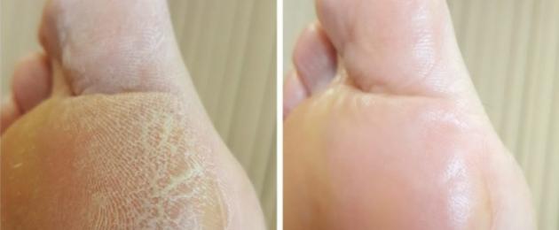 Ipercheratosi: pelle ed epitelio squamoso (foto), trattamento e farmaci.  Ipercheratosi dei piedi: cause, sintomi e trattamenti