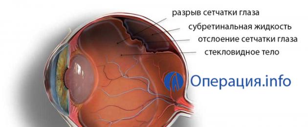 Восстановление сетчатки глаза и зрения. Как укрепить сетчатку глаза без операции: способы, народные рецепты и полезные советы
