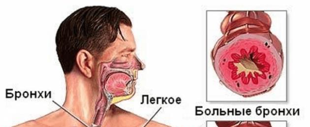 Trattamento della bronchite negli adulti: rimedi popolari testati nel tempo.  Come curare la bronchite a casa: i migliori metodi e rimedi
