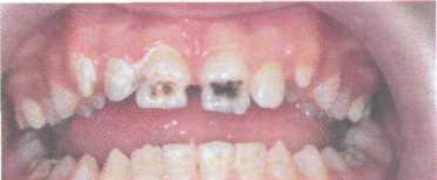 Формы клинического проявления гипоплазии. Гипоплазия эмали молочных зубов