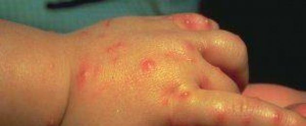Un bambino di cinque mesi ha sviluppato una vescica sulla mano.  Le vesciche sulla pelle sono protuberanze caratteristiche sopra la superficie del derma