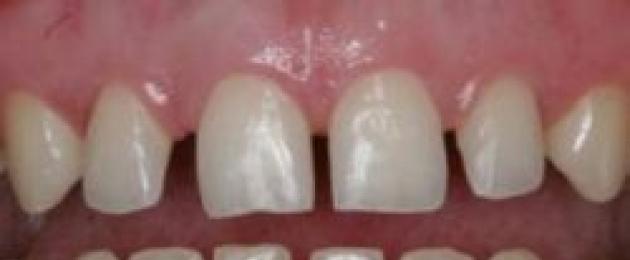 Разошлись передние зубы что делать. Причины развития патологии