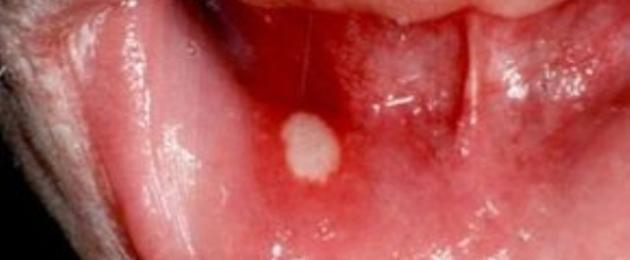 Болячка внутри губы чем лечить. Что означает поражение губ фурункулами и как от них избавиться