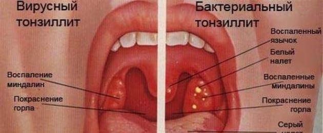 Ma spa per il gonfiore della gola.  Cause e metodi di trattamento efficace del gonfiore della gola e della laringe