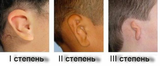 Аномалии развития внутреннего уха и кохлеарная имплантация. Аномалии развития наружного уха Аномалия развития при которой отсутствует внутреннее ухо