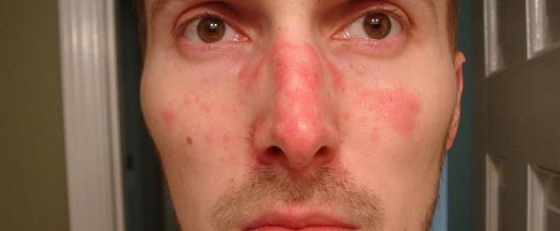 Красные пятна на лице симптомы какой болезни. Красные пятна на лице: причины и лечение. Маски, выравнивающие тон кожи