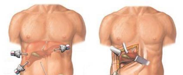 Trattamento diagnostico clinico della colecistite cronica.  Colecistite cronica: eziologia, patogenesi, clinica, diagnosi, trattamento