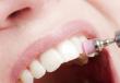 Perché hai bisogno della pulizia professionale dei denti in odontoiatria?