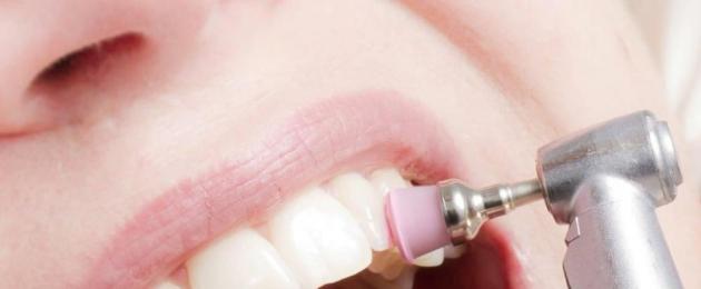لماذا تحتاج إلى تنظيف أسنان احترافي في طب الأسنان؟