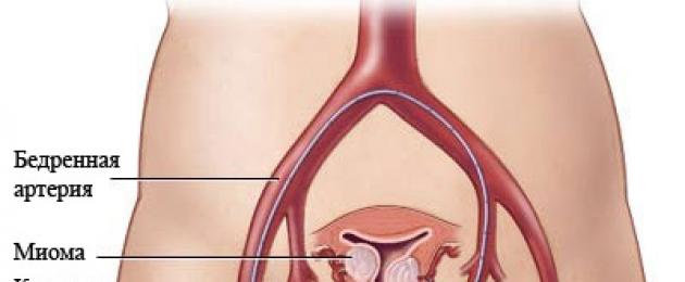 Признаки рождения узла после эма. Эмболизация матки при миоме – этапы ЭМА, результаты эмболизации маточных артерий и цена