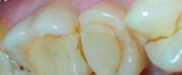 Зубная боль после пломбирования. Что делать если болит зуб после пломбирования под пломбой