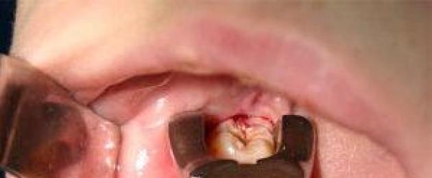 Почему от зуба мудрости болит горло? Может ли от зуба болеть горло. 