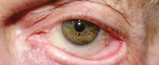 انقلاب الجفن السفلي: طرق العلاج الفعالة.  جسم غريب في العين: ماذا تفعل إذا دخل شيء ما إلى العين أنواع انقلاب الجفن