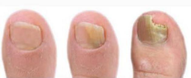 Trattamento dei funghi delle unghie dei piedi con trementina.  Fungo delle unghie