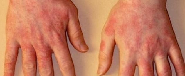 التهاب الجلد على الأصابع من المنظفات.  التهاب الجلد على يدي طفل وشخص بالغ - الأسباب والأعراض والعلاج بالمراهم والعلاجات الشعبية
