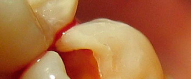 Зуб болит на холодное после пломбирования. Сколько может болеть зуб после пломбирования каналов