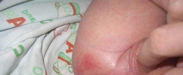 Trattamento della dermatite da pannolino nei bambini.  Dermatite da pannolino
