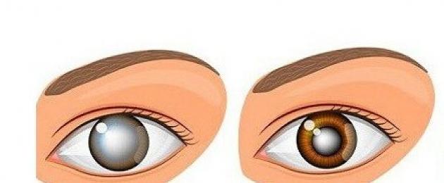 Симптомы катаракты и глаукомы глаза у взрослых. Отличие катаракты и глаукомы - какая разница межу заболеваниями, и что хуже? Симптомы одновременного течения