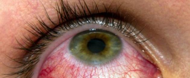 كيفية إزالة التورم من العيون الملطخة بالدموع.  الوقاية والوقاية