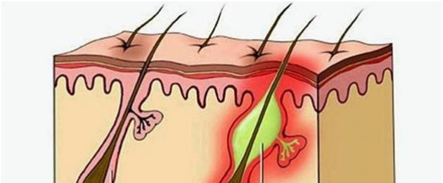 Labbra piccole nelle donne.  Infezioni che portano alla comparsa di noduli nella zona delle labbra.  Come si sviluppano i sintomi