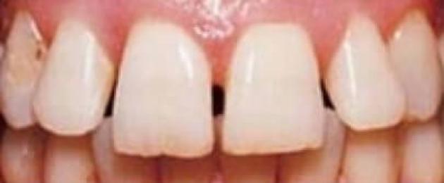 Crea uno spazio tra i denti anteriori.  Apparecchi ortodontici, apparecchi di contenzione e paradenti: cambio di direzione nel tempo
