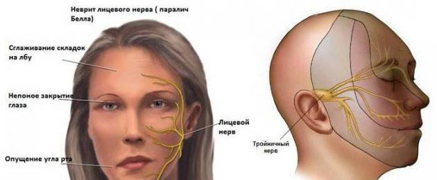 Герпетическая невропатия лицевого нерва. Идиопатическая невропатия лицевого нерва (паралич Белла)