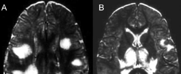 Encefalomielite acuta disseminata.  Trattamento e prevenzione delle complicanze dell'encefalomielite acuta disseminata nella fase iniziale della malattia