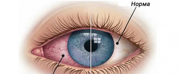 Необычные болезни глаз у человека. Нарушения​ ​периферического​ ​зрения