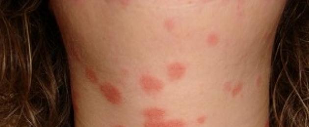 Аллергия может быть по всему телу. Аллергические пятна
