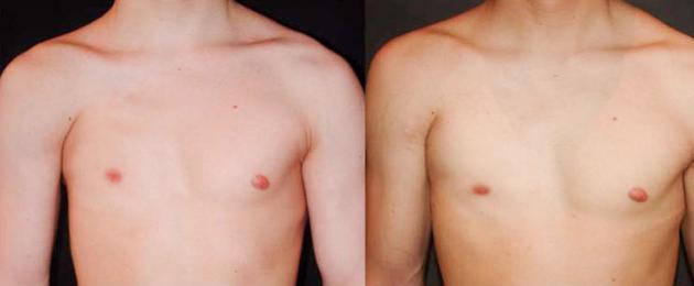 Отсутствие грудной мышцы у мужчин. Отделение торакальной хирургии