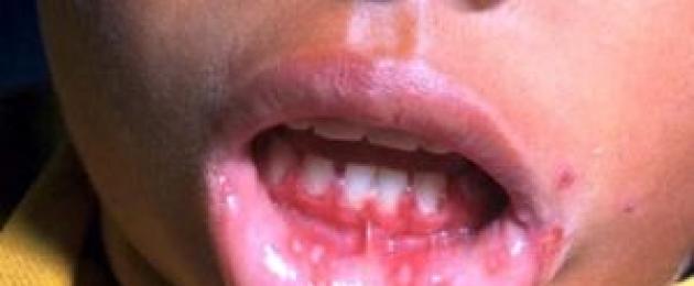 كيفية التعرف على التهاب الفم البكتيري عند الأطفال.  علاج