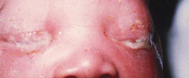 Профилактика бленнореи у новорожденных. Бленнорея у новорожденных или контакт гонококков с глазами