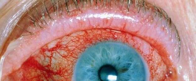 Cause dell'uveite oculare.  Uveite (acuta, cronica, lenta): cause, sintomi, diagnosi e trattamento