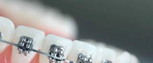 Курс к ровным зубам: когда и как ставят брекеты детям? Установка брекетов видео. 