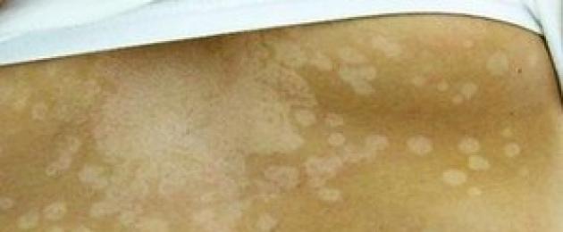 Perché si forma il lichene solare e come curarlo?  Come trattare i funghi solari sulla pelle.